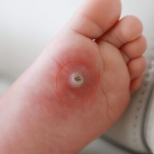 Ojo de pescado en el pie ¿Cómo surge y cómo quitarlo Raza Folklorica!